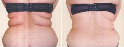 lipolysis, lipodissolve, london uk