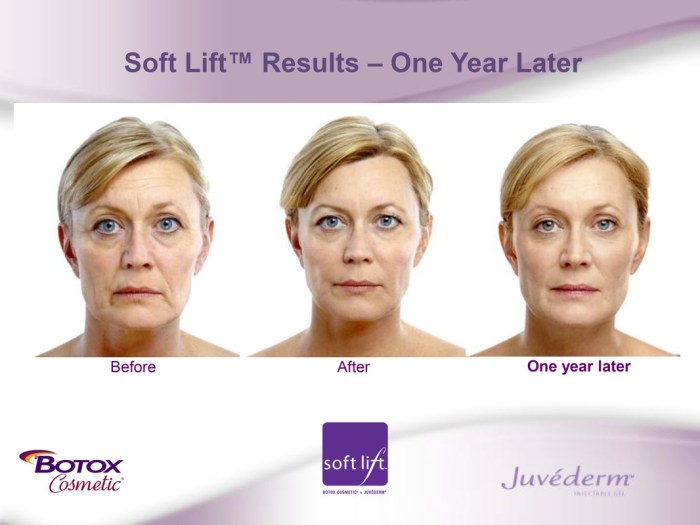 Non surgical facelift 