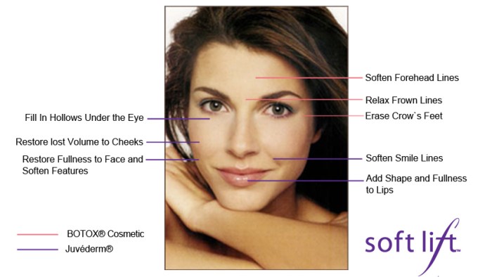 Botox SoftLift London 