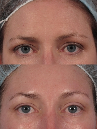 Botox brow lift, london UK 