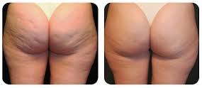  Lipolysis london