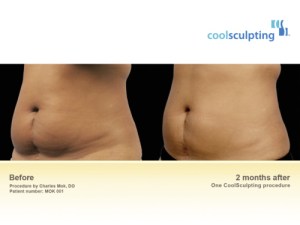 coolsculpting before after London Dr Kacem