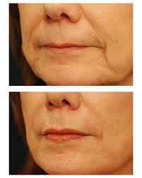 Best Smoker Lines treatment London