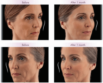 Malar Lift, juvederm voluma, London, dr kacem
