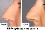 Best nose job London