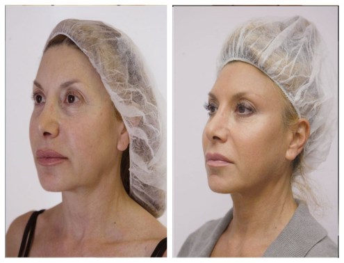 Thread lift silhouette soft Monaco