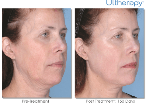 Ultherapy lift Monaco