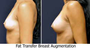 Fat-Transfer-Breast 22
