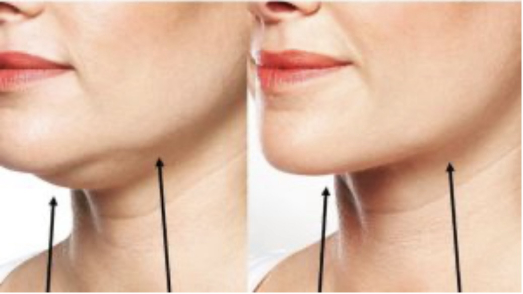 Best kybella, belkyra good cost prices London, Harley St