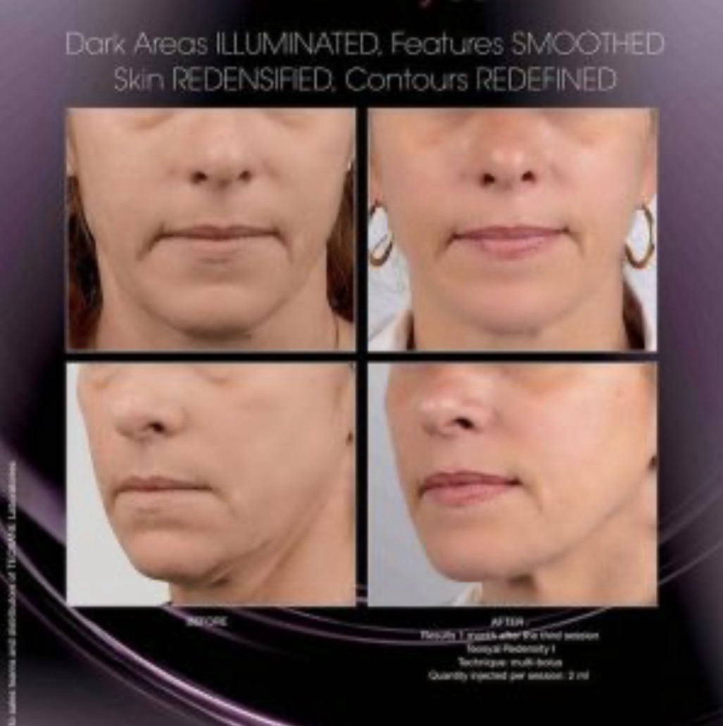 Skin Boosters London U.K.