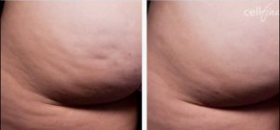 Cellfina cellulite treatment London UK 