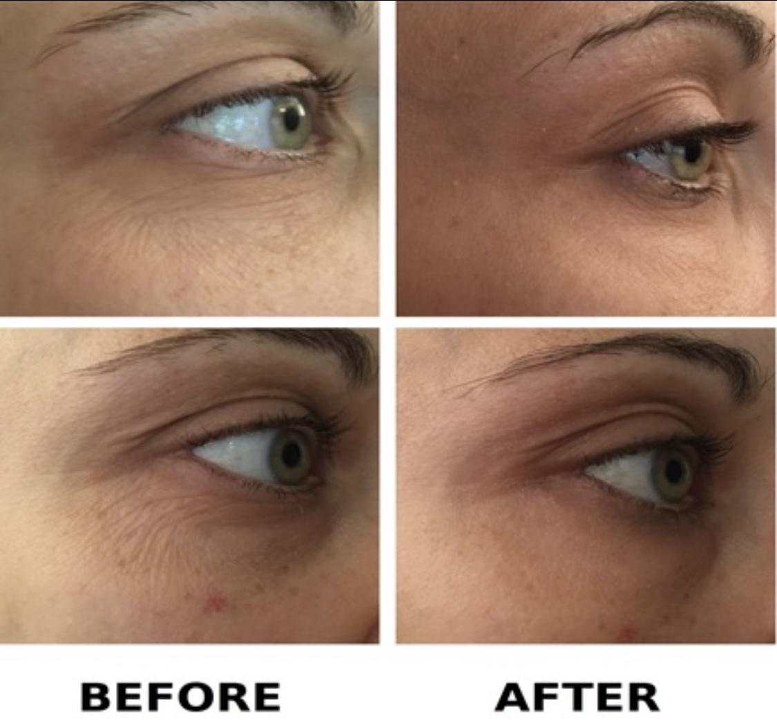 Skin Micro-needling, Radara, Dermapen, London