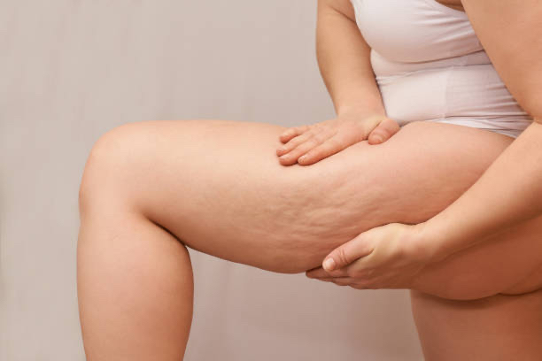 Best affordable Cellulite treatment reduction London, UK