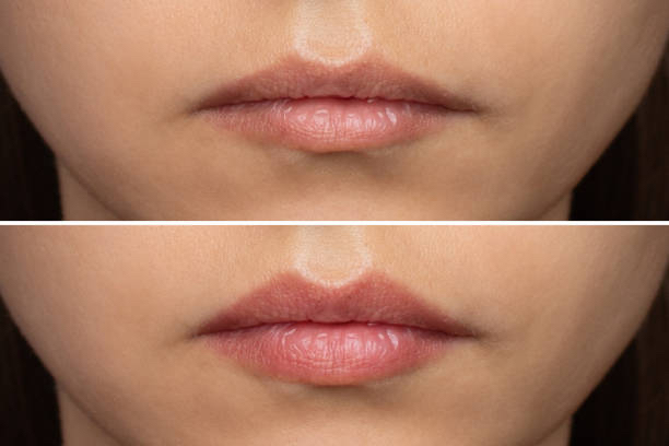 Lip filler before after 