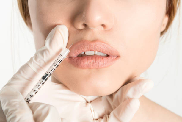 Professional Lip Augmentation in London, Get the Perfect Pout